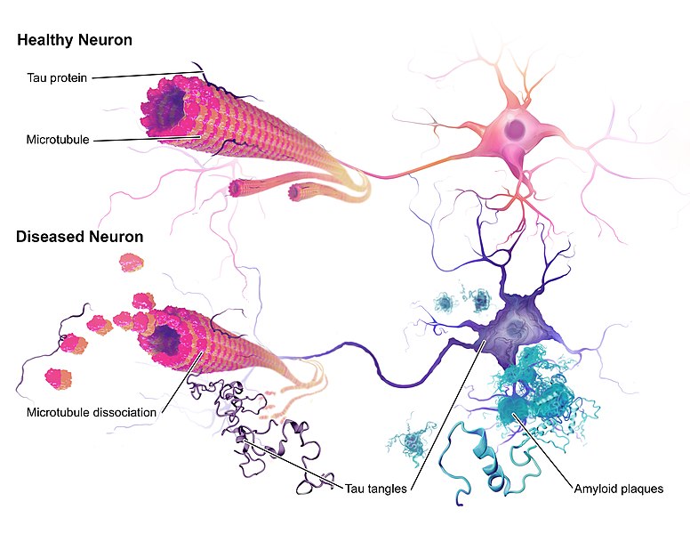 Alzheimers_Disease_ neurons_Alzheimer vaccinations